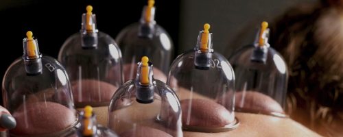 cupping